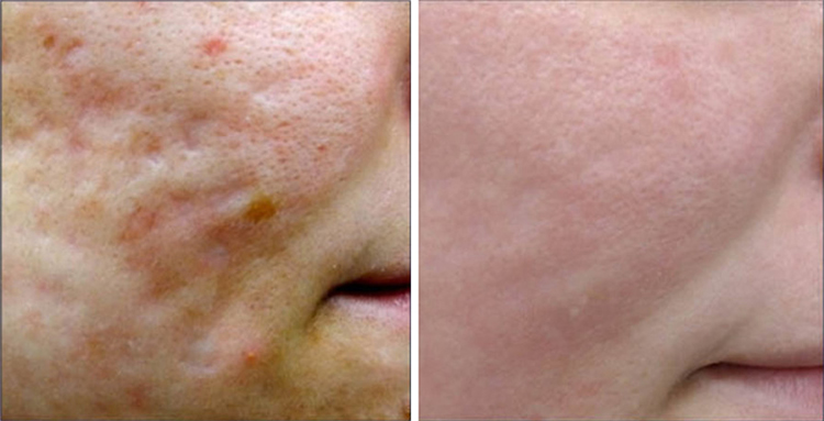 Treating Acne Scars with CO2 Laser
