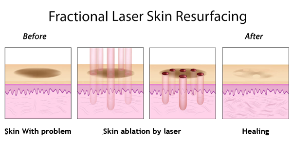 How CO2 Laser Works