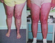 Varicose Vein Treatment